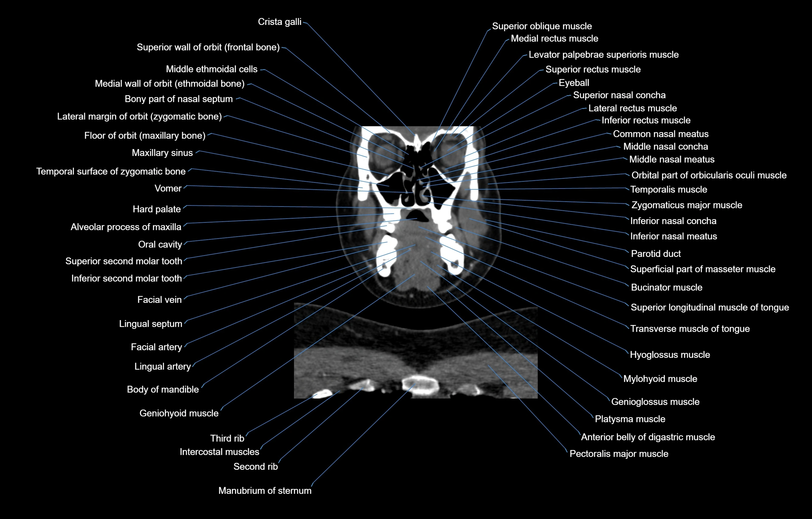 CT Neck coronal  cross sectional anatomy labelled 3D  radiology  image-00018.webp